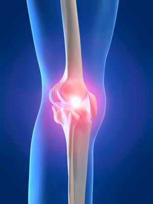 Dolor de rodilla: una solucion rapida y eficaz para el sindrome rotuliano